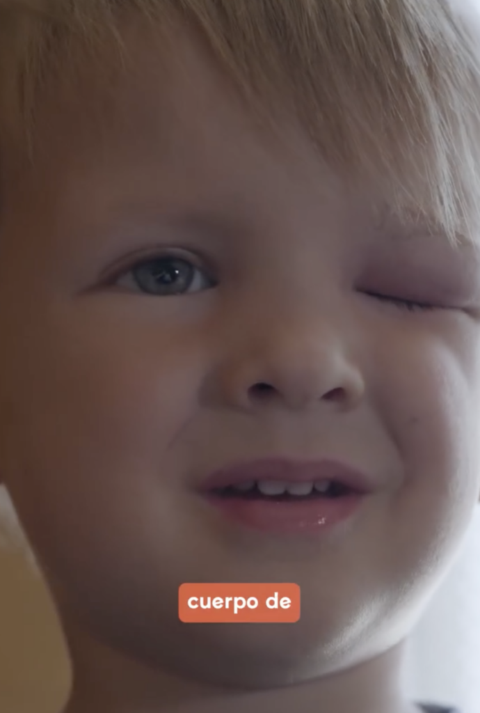 ¿Has oído hablar del angioedema hereditario?